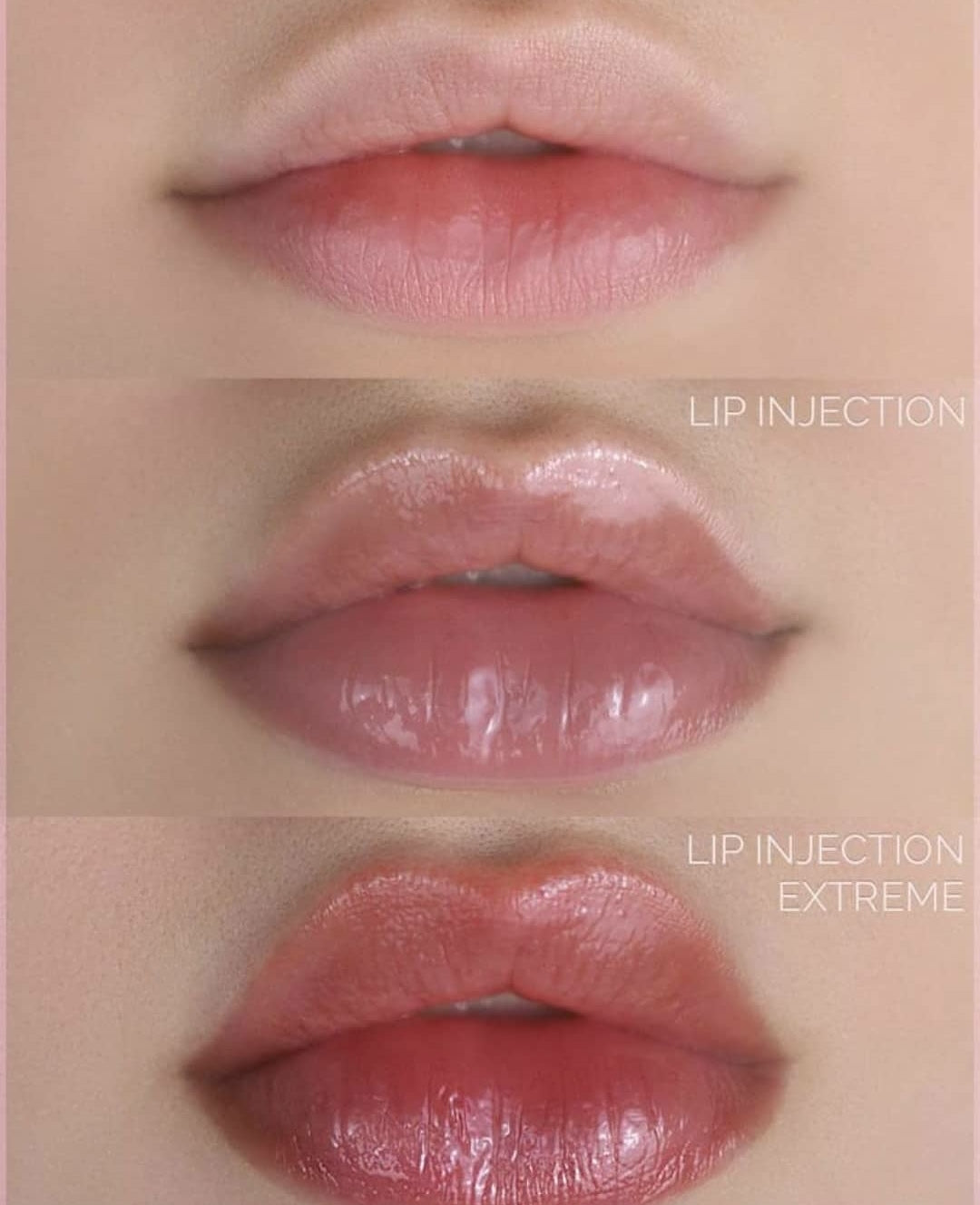 Lip injection extreme Lip Plumper