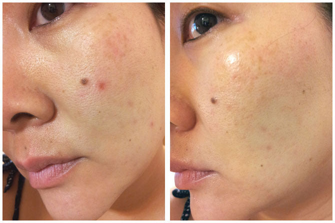 Super Spot Remover Acne Treatment Gel