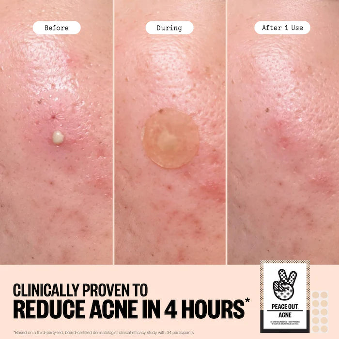 Salicylic Acid & Hydrocolloid Acne Treatment Pimple Patches