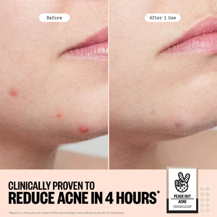Salicylic Acid & Hydrocolloid Acne Treatment Pimple Patches