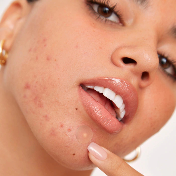 Salicylic Acid & Hydrocolloid Acne Treatment Pimple Patches